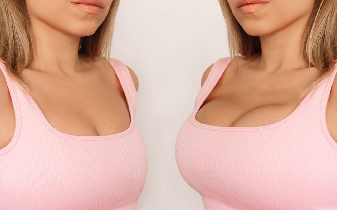 Young woman in pink top before and after breast augmentation with silicone implants