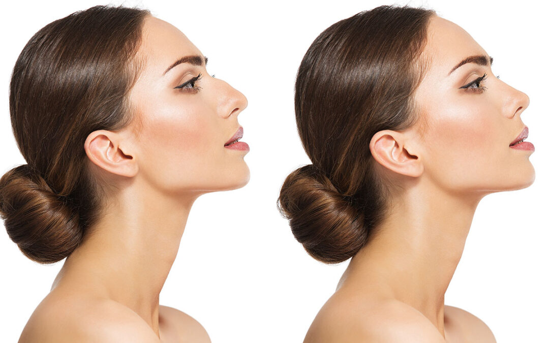 Women nose shape before and after plastic surgery