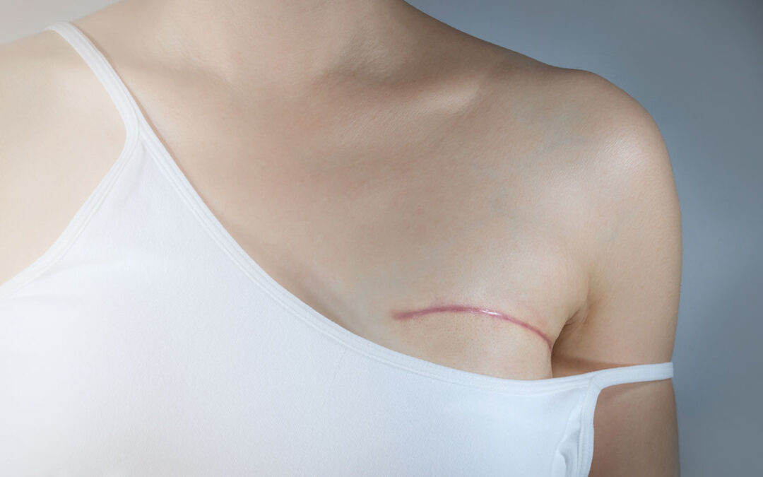 Woman shows scar from mastectomy of operation of her breast cancer