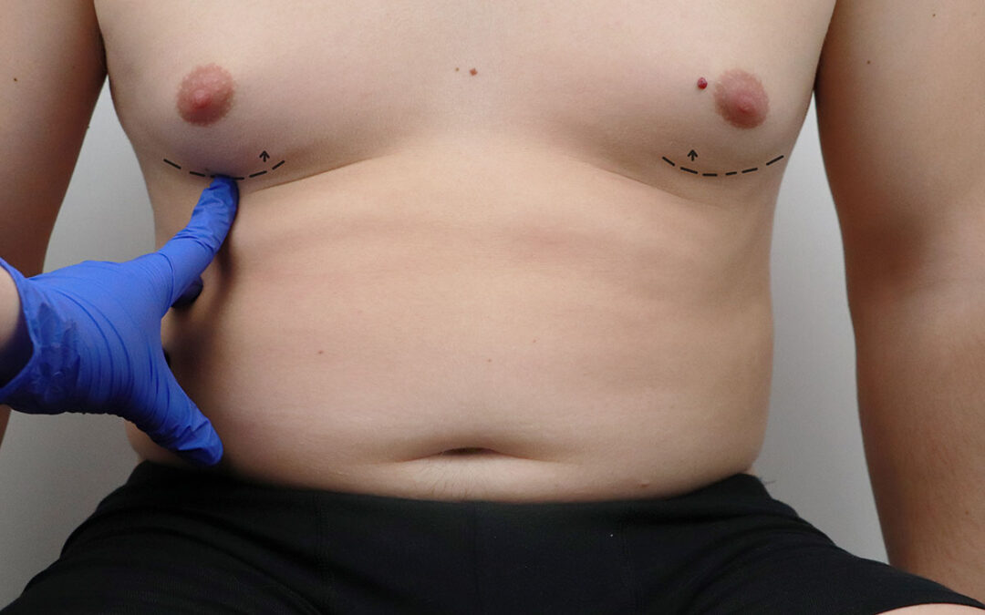 A plastic surgeon prepares a man for plastic surgery