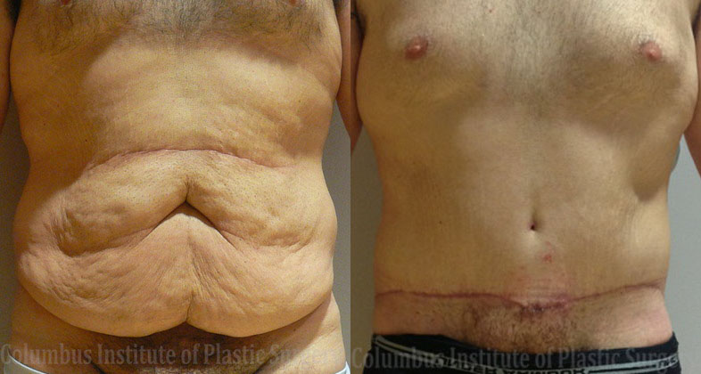 Belt Lipectomy before and after photo by Columbus Institute of Plastic Surgery in Columbus, OH