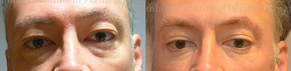 Blepharoplasty before and after photo by Columbus Institute of Plastic Surgery in Columbus, OH
