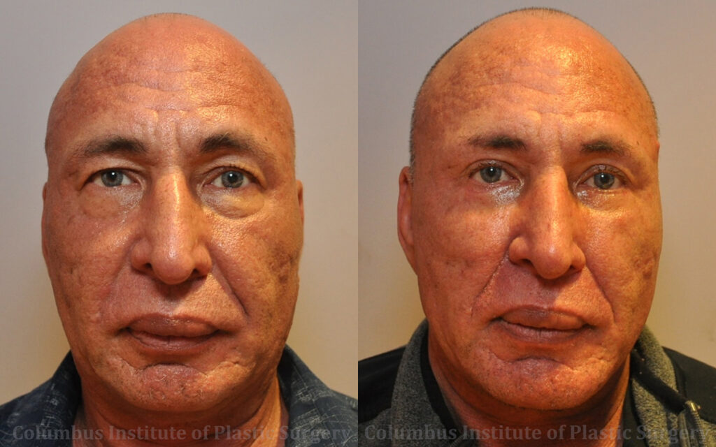 Chin Implant before and after photo by Columbus Institute of Plastic Surgery in Columbus, OH