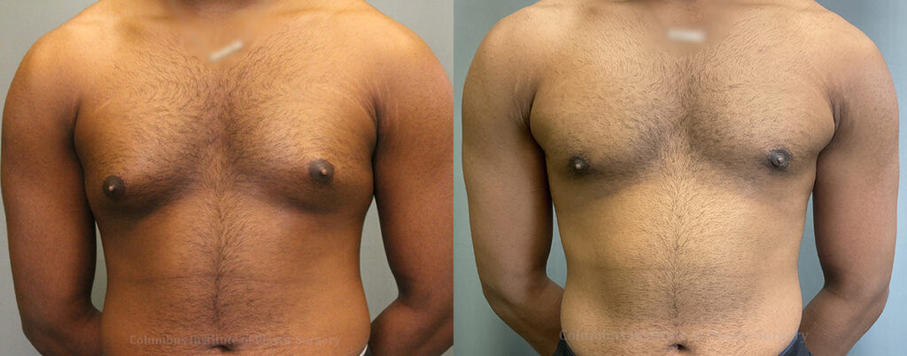 Gynecomastia before and after photo by Columbus Institute of Plastic Surgery in Columbus, OH