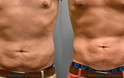 Lasers before and after photo by Columbus Institute of Plastic Surgery in Columbus, OH Lasers before and after photo by Columbus Institute of Plastic Surgery in Columbus, OH