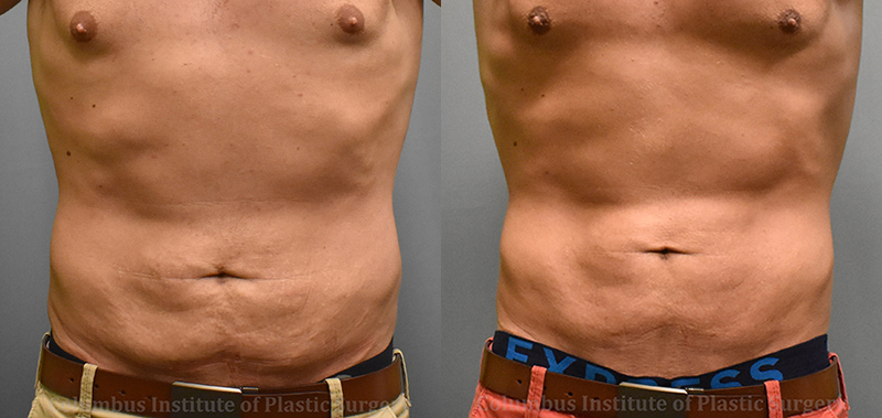 Lasers before and after photo by Columbus Institute of Plastic Surgery in Columbus, OH