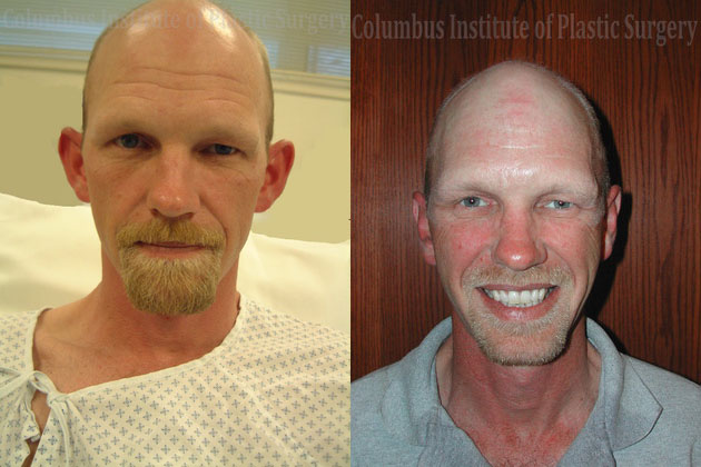 Otoplasty before and after photo by Columbus Institute of Plastic Surgery in Columbus, OH