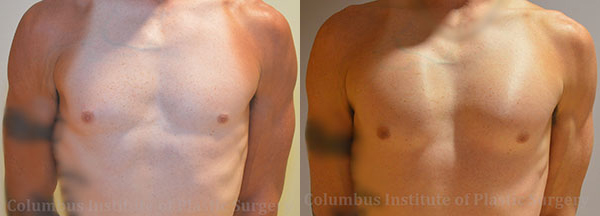 Pectoral Augmentation before and after photo by Columbus Institute of Plastic Surgery in Columbus, OH