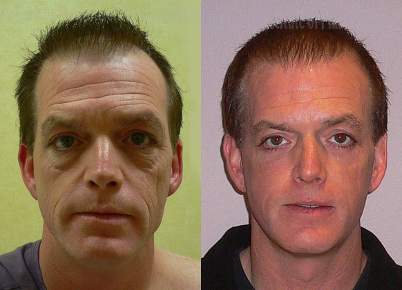 Phenol Chemical Peel before and after photo by Columbus Institute of Plastic Surgery in Columbus, OH