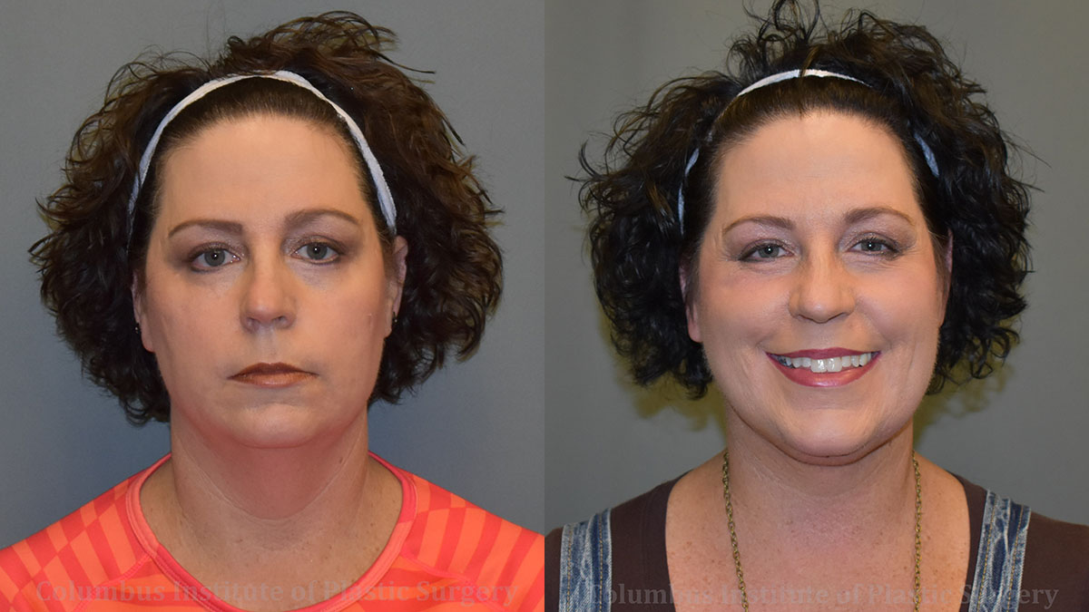 Suture Necklift before and after photo by Columbus Institute of Plastic Surgery in Columbus, OH Suture Necklift before and after photo by Columbus Institute of Plastic Surgery in Columbus, OH