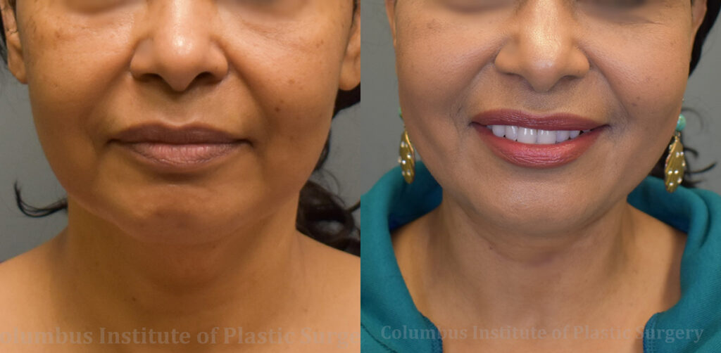 Thread Lift before and after photo by Columbus Institute of Plastic Surgery in Columbus, OH