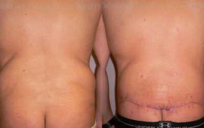 Belt Lipectomy before and after photo by Columbus Institute of Plastic Surgery in Columbus, OH Belt Lipectomy before and after photo by Columbus Institute of Plastic Surgery in Columbus, OH