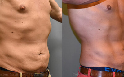 Lasers before and after photo by Columbus Institute of Plastic Surgery in Columbus, OH Lasers before and after photo by Columbus Institute of Plastic Surgery in Columbus, OH