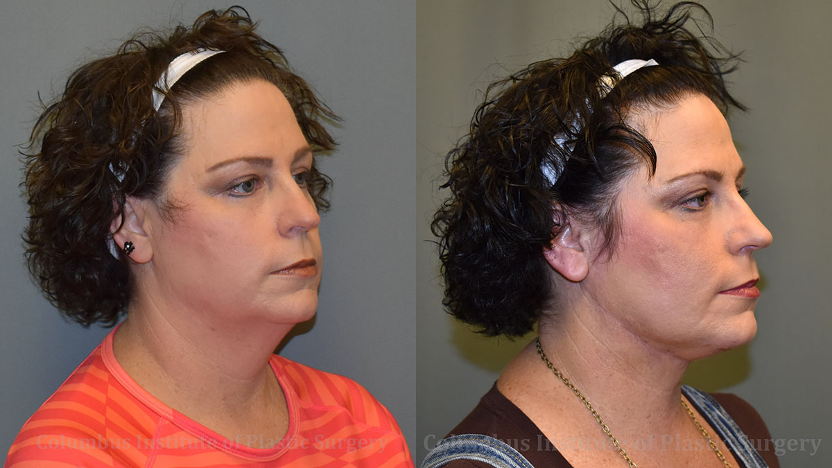 Suture Necklift before and after photo by Columbus Institute of Plastic Surgery in Columbus, OH Suture Necklift before and after photo by Columbus Institute of Plastic Surgery in Columbus, OH