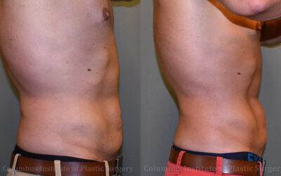 Lasers before and after photo by Columbus Institute of Plastic Surgery in Columbus, OH Lasers before and after photo by Columbus Institute of Plastic Surgery in Columbus, OH