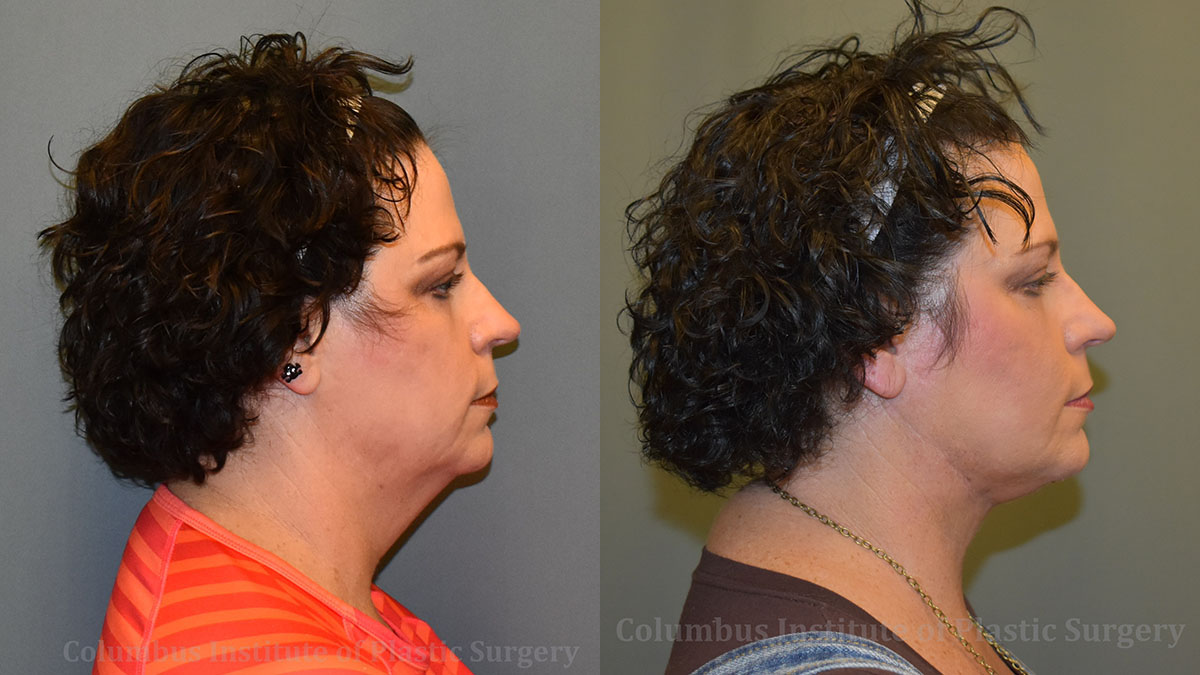 Suture Necklift before and after photo by Columbus Institute of Plastic Surgery in Columbus, OH Suture Necklift before and after photo by Columbus Institute of Plastic Surgery in Columbus, OH