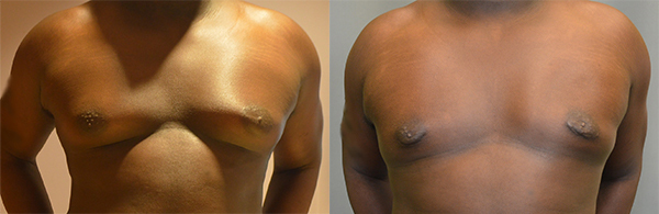 Gynecomastia before and after photo by Columbus Institute of Plastic Surgery in Columbus, OH