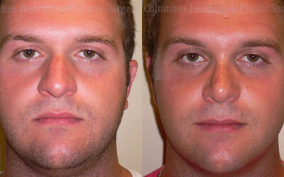 Rhinoplasty before and after photo by Columbus Institute of Plastic Surgery in Columbus, OH Rhinoplasty before and after photo by Columbus Institute of Plastic Surgery in Columbus, OH
