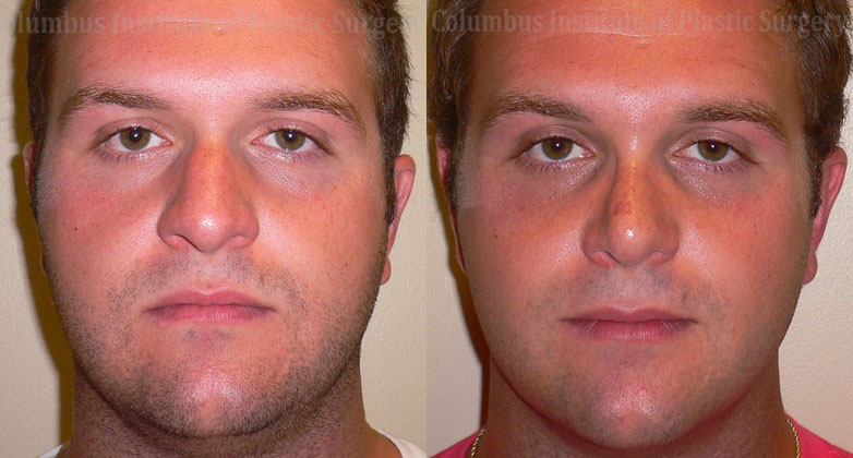 Rhinoplasty before and after photo by Columbus Institute of Plastic Surgery in Columbus, OH