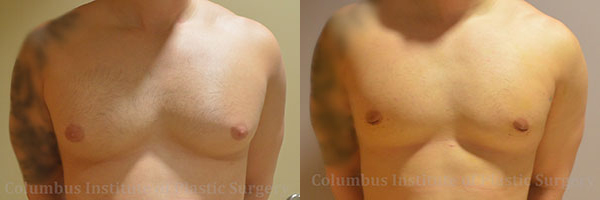 Gynecomastia before and after photo by Columbus Institute of Plastic Surgery in Columbus, OH
