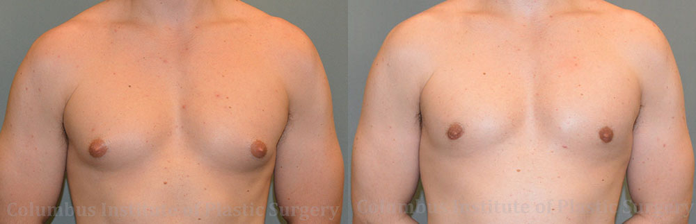 Gynecomastia before and after photo by Columbus Institute of Plastic Surgery in Columbus, OH