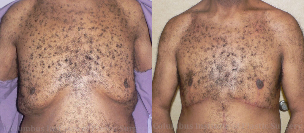 Gynecomastia before and after photo by Columbus Institute of Plastic Surgery in Columbus, OH