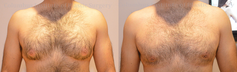 Gynecomastia before and after photo by Columbus Institute of Plastic Surgery in Columbus, OH