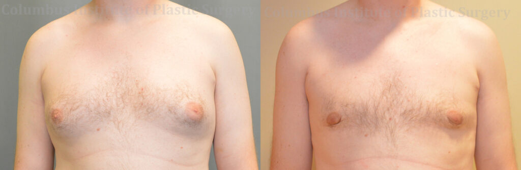 Gynecomastia before and after photo by Columbus Institute of Plastic Surgery in Columbus, OH