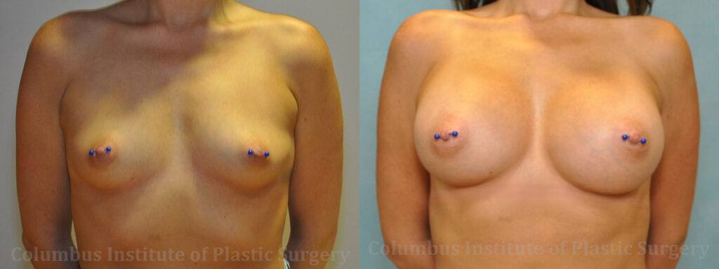 Breast Augmentation before and after photo by Columbus Institute of Plastic Surgery in Columbus, OH