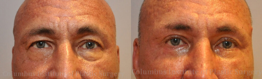 Blepharoplasty before and after photo by Columbus Institute of Plastic Surgery in Columbus, OH