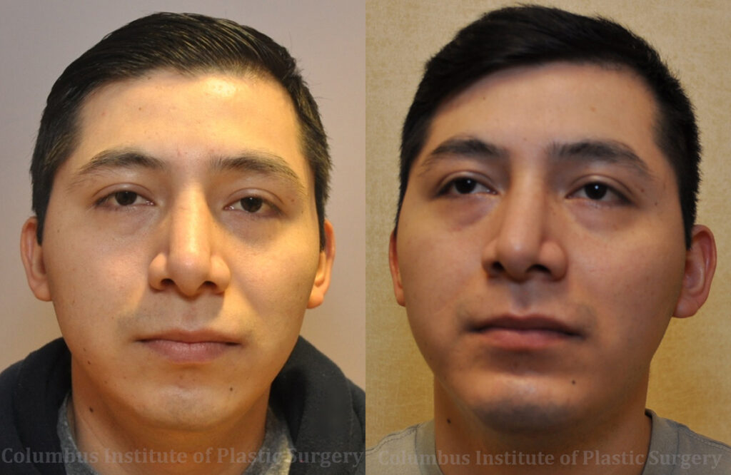 Chin Implant before and after photo by Columbus Institute of Plastic Surgery in Columbus, OH