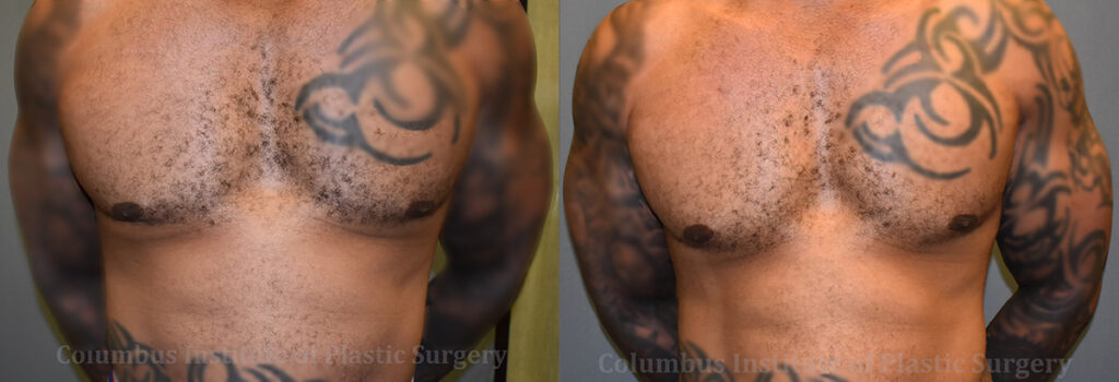 Lasers before and after photo by Columbus Institute of Plastic Surgery in Columbus, OH