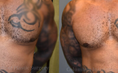Lasers before and after photo by Columbus Institute of Plastic Surgery in Columbus, OH Lasers before and after photo by Columbus Institute of Plastic Surgery in Columbus, OH