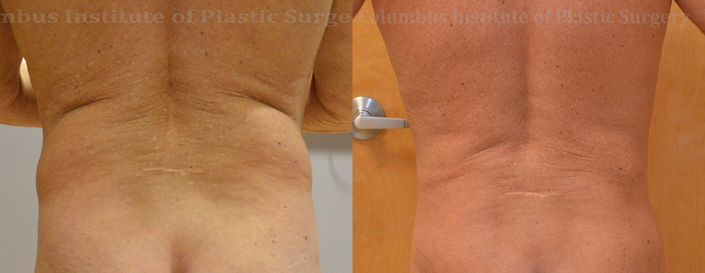 Liposuction before and after photo by Columbus Institute of Plastic Surgery in Columbus, OH