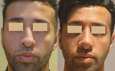 Rhinoplasty before and after photo by Columbus Institute of Plastic Surgery in Columbus, OH Rhinoplasty before and after photo by Columbus Institute of Plastic Surgery in Columbus, OH