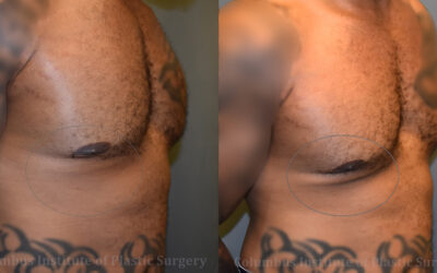 Lasers before and after photo by Columbus Institute of Plastic Surgery in Columbus, OH Lasers before and after photo by Columbus Institute of Plastic Surgery in Columbus, OH