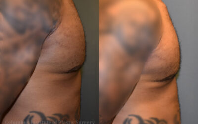 Lasers before and after photo by Columbus Institute of Plastic Surgery in Columbus, OH Lasers before and after photo by Columbus Institute of Plastic Surgery in Columbus, OH