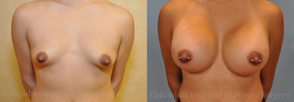 Breast Augmentation before and after photo by Columbus Institute of Plastic Surgery in Columbus, OH