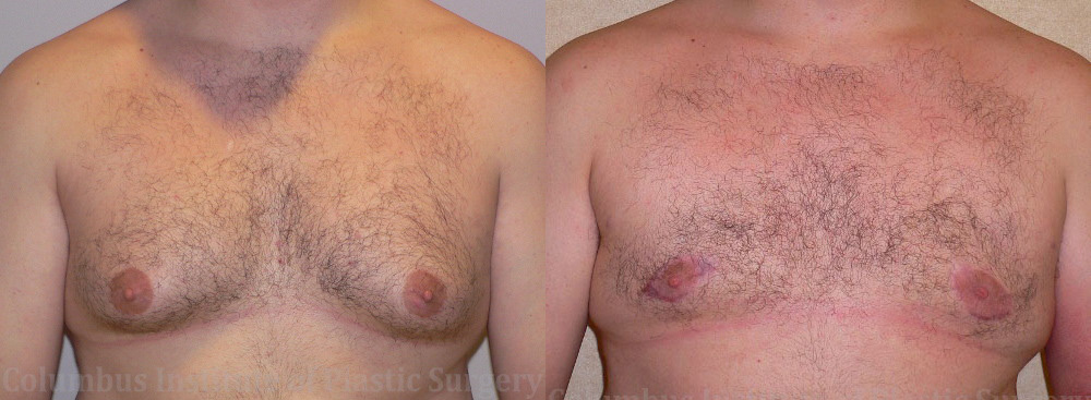 Gynecomastia before and after photo by Columbus Institute of Plastic Surgery in Columbus, OH