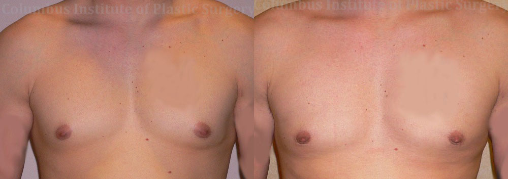 Gynecomastia before and after photo by Columbus Institute of Plastic Surgery in Columbus, OH