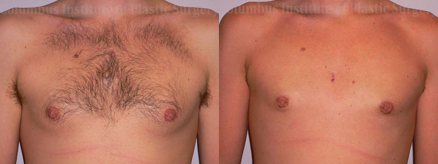 Gynecomastia before and after photo by Columbus Institute of Plastic Surgery in Columbus, OH