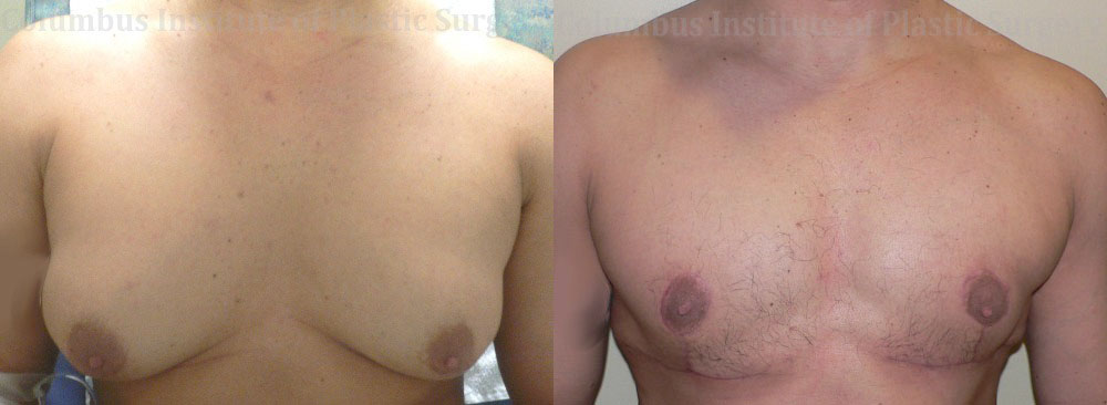 Gynecomastia before and after photo by Columbus Institute of Plastic Surgery in Columbus, OH