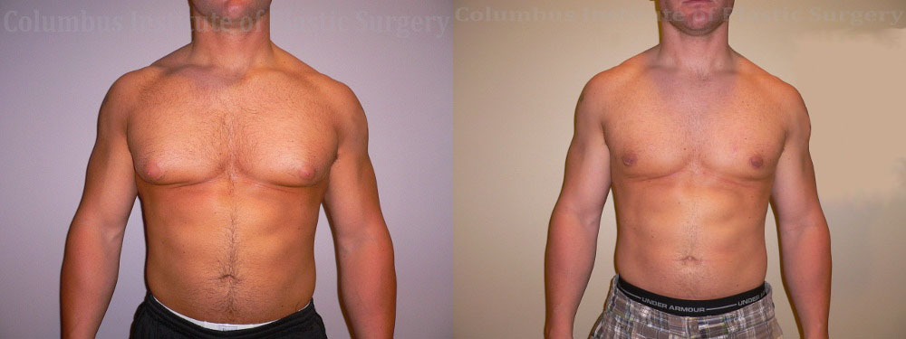 Gynecomastia before and after photo by Columbus Institute of Plastic Surgery in Columbus, OH