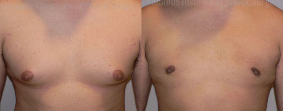 Gynecomastia before and after photo by Columbus Institute of Plastic Surgery in Columbus, OH