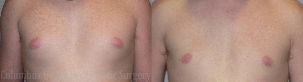 Gynecomastia before and after photo by Columbus Institute of Plastic Surgery in Columbus, OH