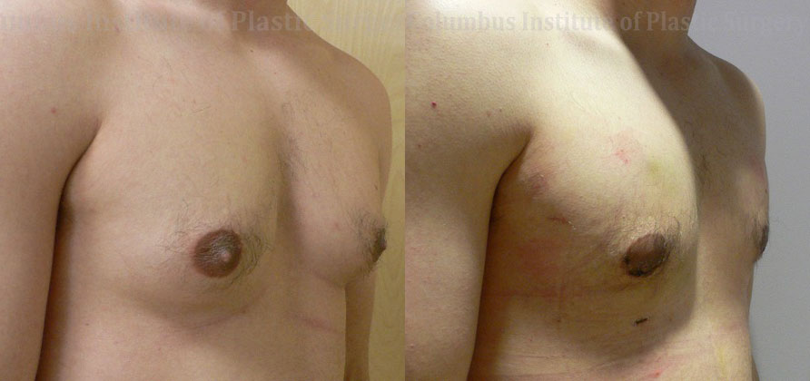 Gynecomastia before and after photo by Columbus Institute of Plastic Surgery in Columbus, OH