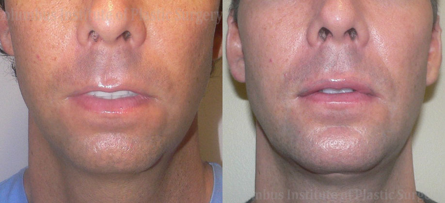 Chin Implant before and after photo by Columbus Institute of Plastic Surgery in Columbus, OH