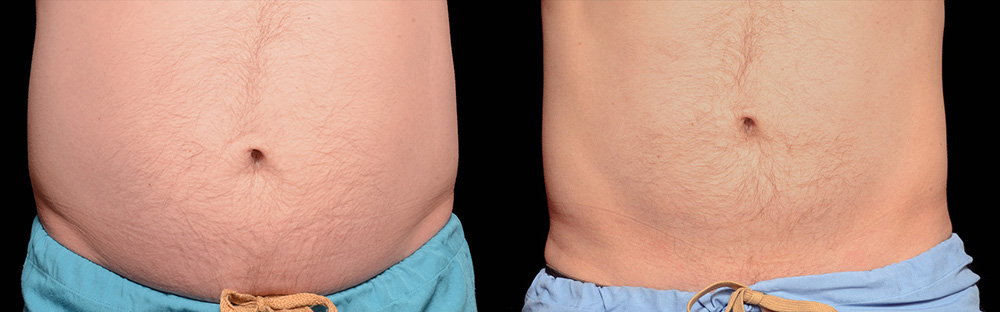 CoolSculpting before and after photo by Columbus Institute of Plastic Surgery in Columbus, OH CoolSculpting before and after photo by Columbus Institute of Plastic Surgery in Columbus, OH