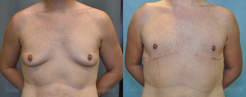 Gynecomastia before and after photo by Columbus Institute of Plastic Surgery in Columbus, OH