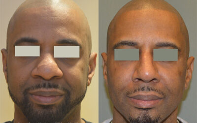 Rhinoplasty before and after photo by Columbus Institute of Plastic Surgery in Columbus, OH Rhinoplasty before and after photo by Columbus Institute of Plastic Surgery in Columbus, OH